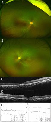 AIRE Gene Mutation Presenting at Age 2 Years With Autoimmune Retinopathy and Steroid-Responsive Acute Liver Failure: A Case Report and Literature Review